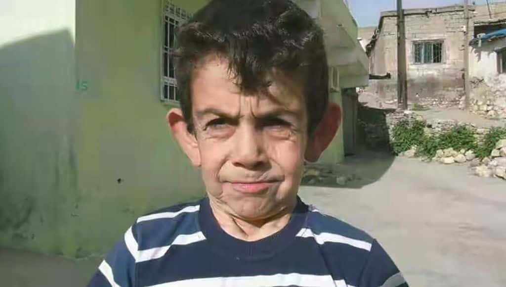 الشيخوخة المبكرة