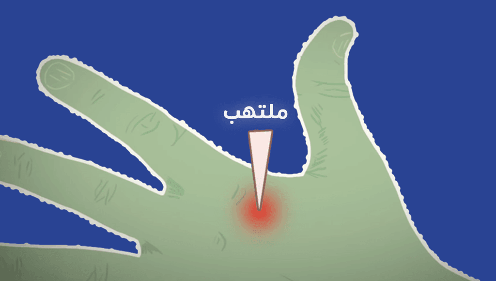 ملتهب