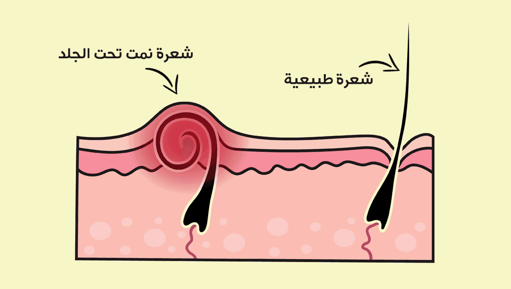 مشكلة الشعر الذي ينمو تحت الجلد