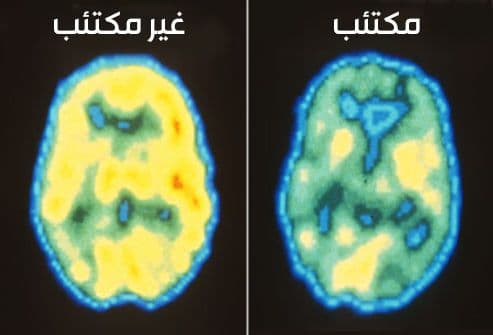 دماغ المكتئب