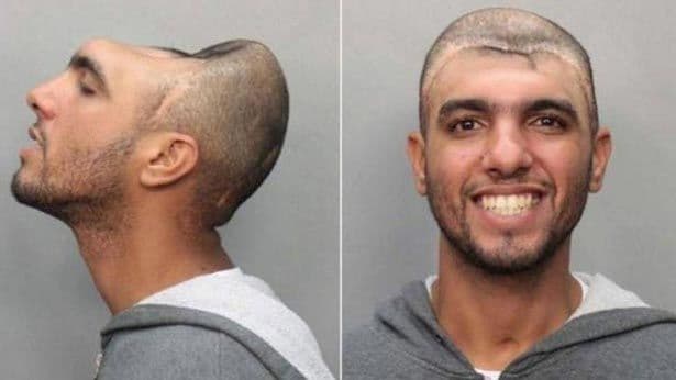 الشاب كارلوس رودريغيز يعيش بنصف رأس
