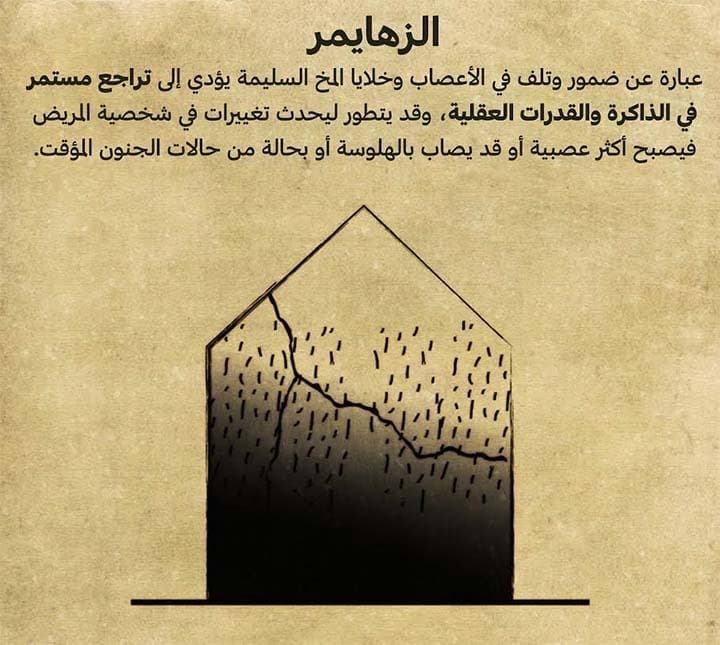 الزهايمر