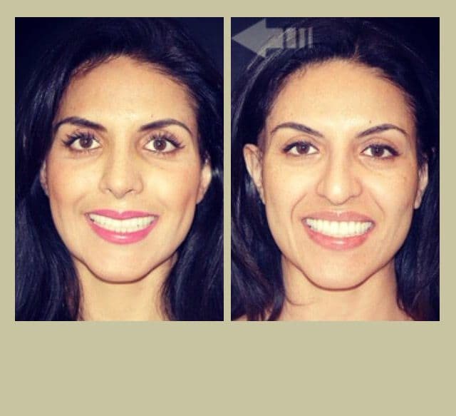 عمليات تجميل الانف في ايران