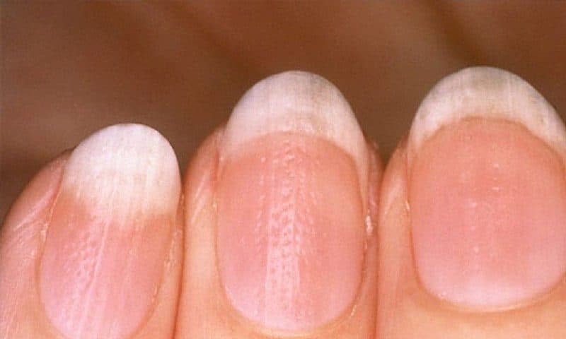 الأظافر الغائرة Pitted Nails