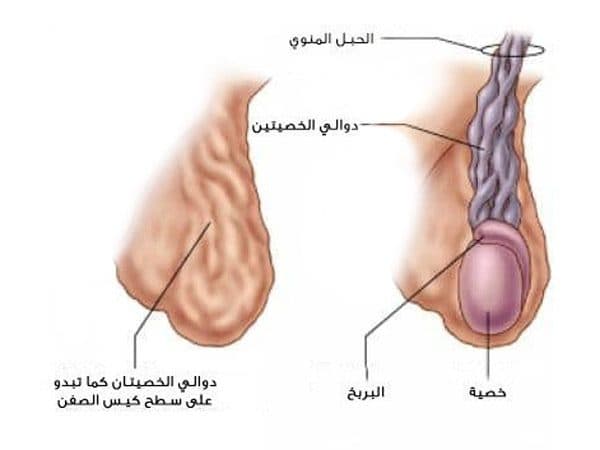 صورة توضيحية تبرز حالة دوالي الخصيتين.