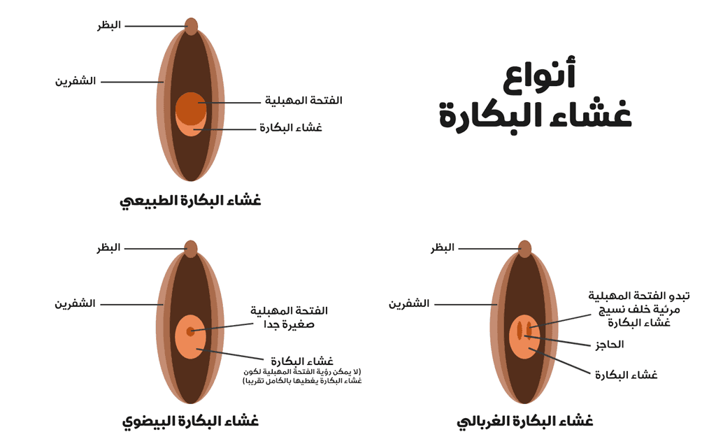 أنواع وأنماط غشاء البكارة