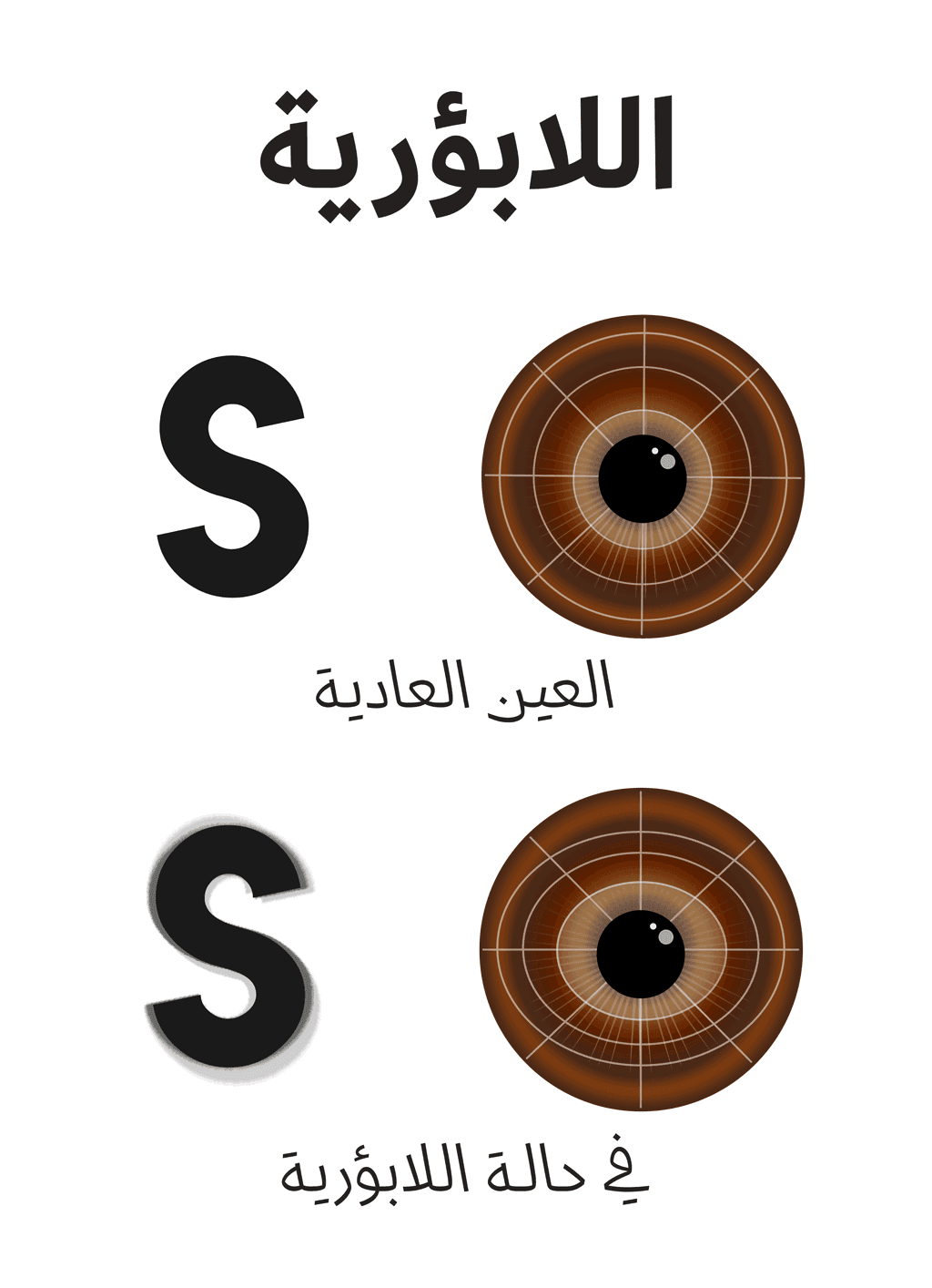 تحدث اللابؤرية عندما يكون شكل القرنية أشبه بالبطيخة بدلاً من كونه كروياً، ونستطيع أن نلاحظ أن حواف الحرف المرسوم غير واضحة في حالة اللابؤرية.