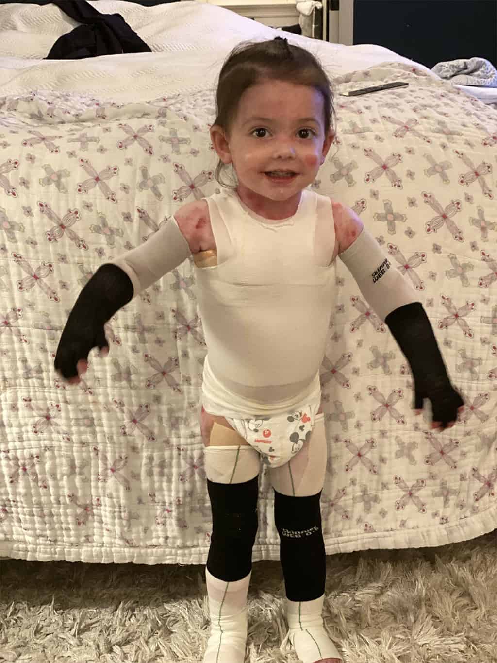 طفلة مصابة بمرض انحلال البشرة الفقاعي
