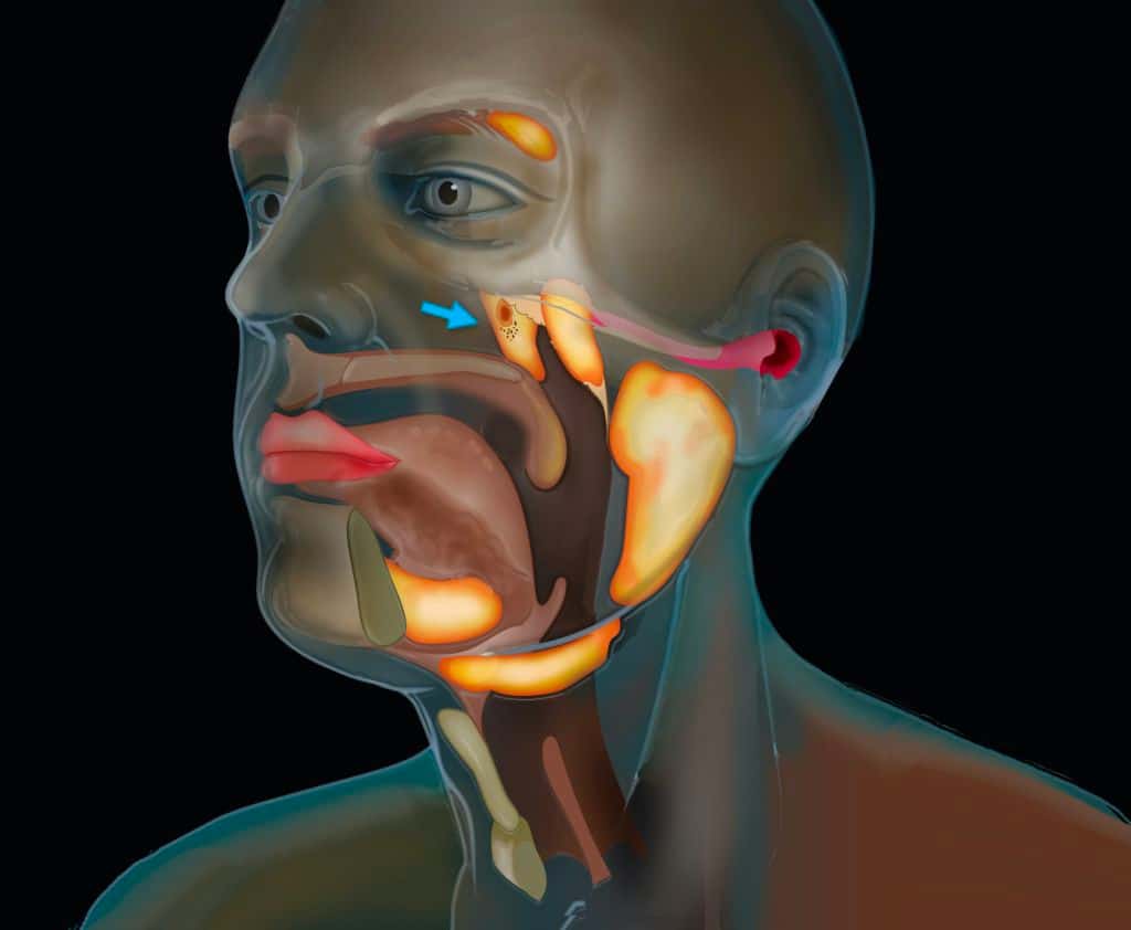 توجد هاتان الغدتان في مكان اتصال الأذنين بالحنجرة في قاعدة الجمجمة. صورة: The Netherlands Cancer Institute