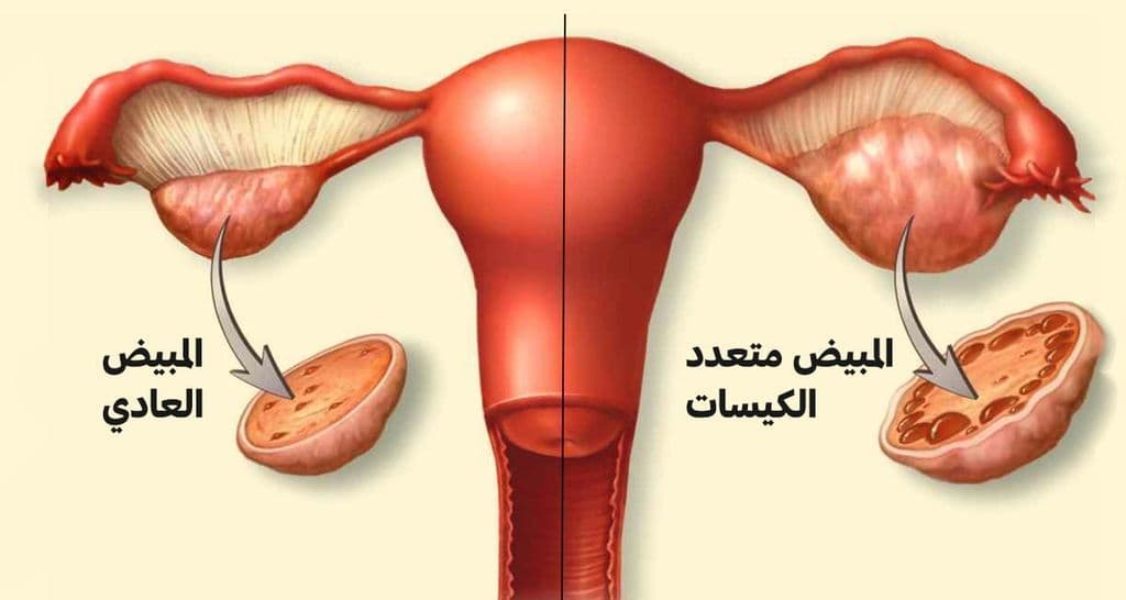 متلازمة المبيض متعدد الكيسات