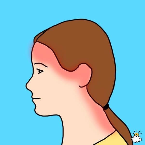 صداع الإجهاد