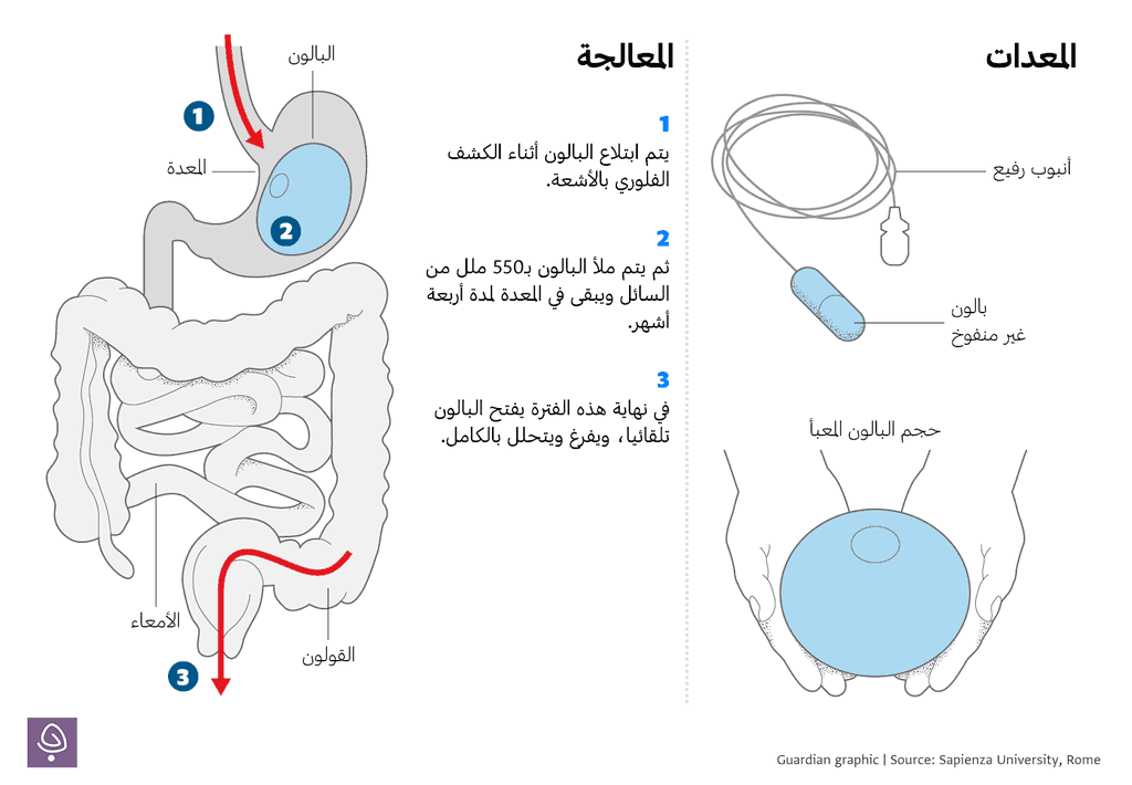 البالون البيضاوي القابل للابتلاع