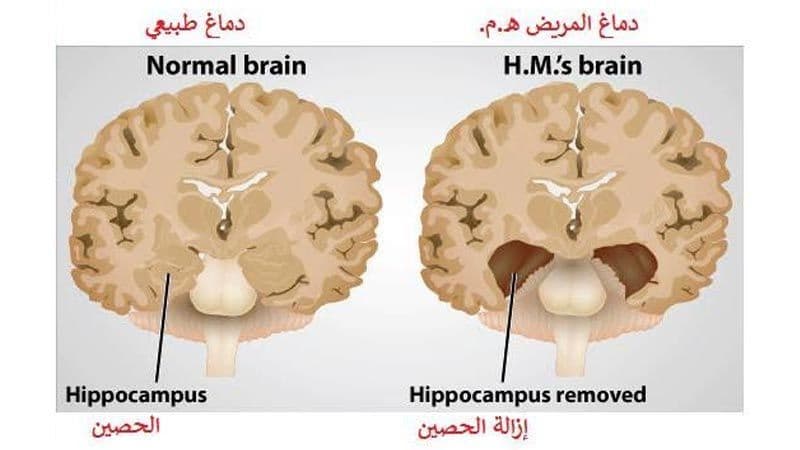 إزالة الحصين من الدماغ