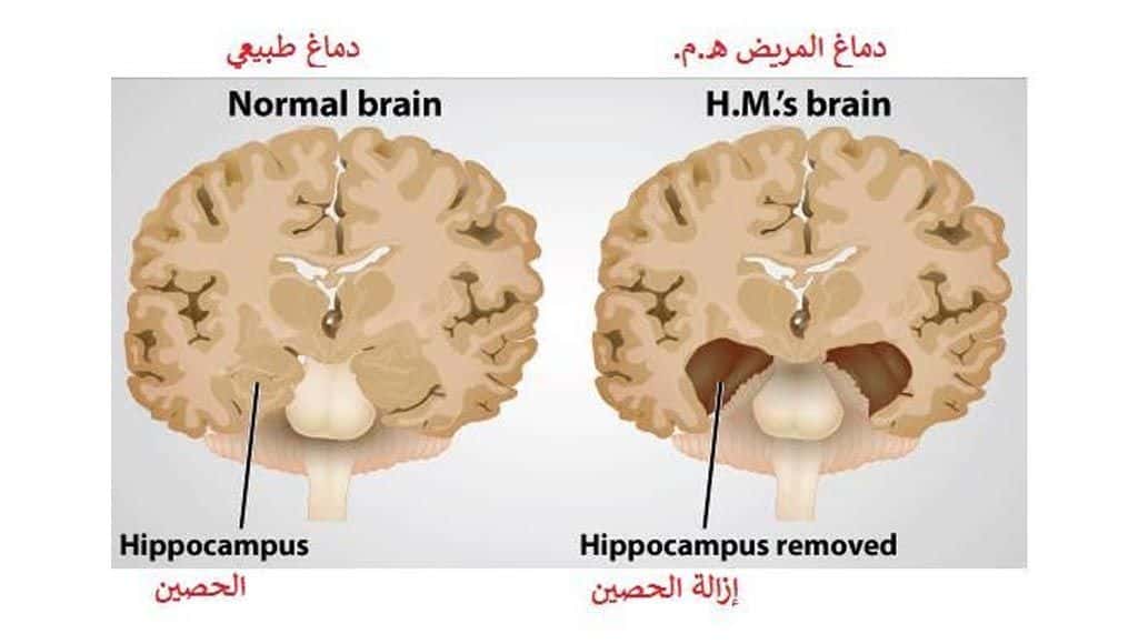 دخلك بتعرف أشهر مريض في تاريخ علم الأعصاب؟