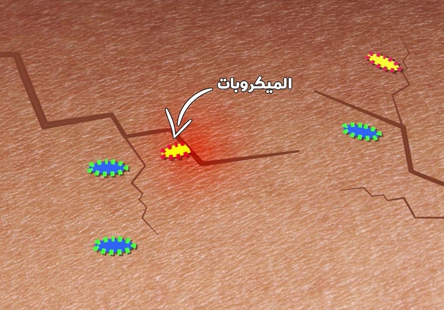 تشققات البشرة الجافة