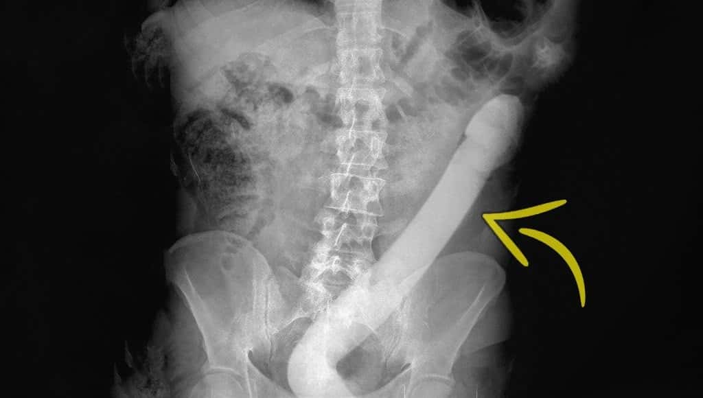 صورة بالأشعة السينية لأمعاء شخص تحتوي على قضيب اصطناعي