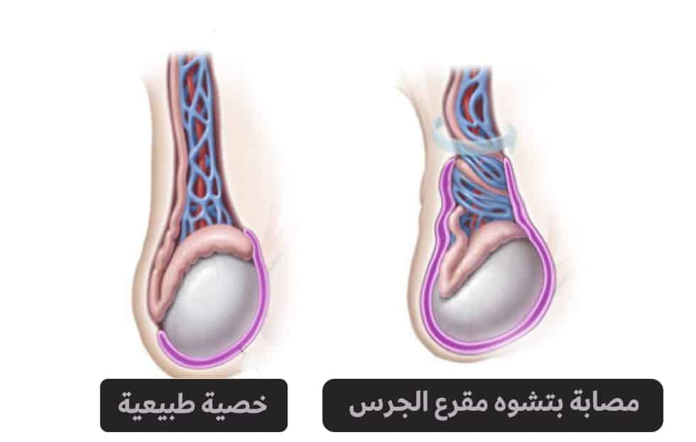 تشوه مقرعة الجرس.