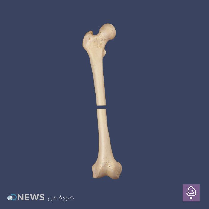 سحب الدشبذ أو تكوين العظم السحبي - Distraction Osteogenesis