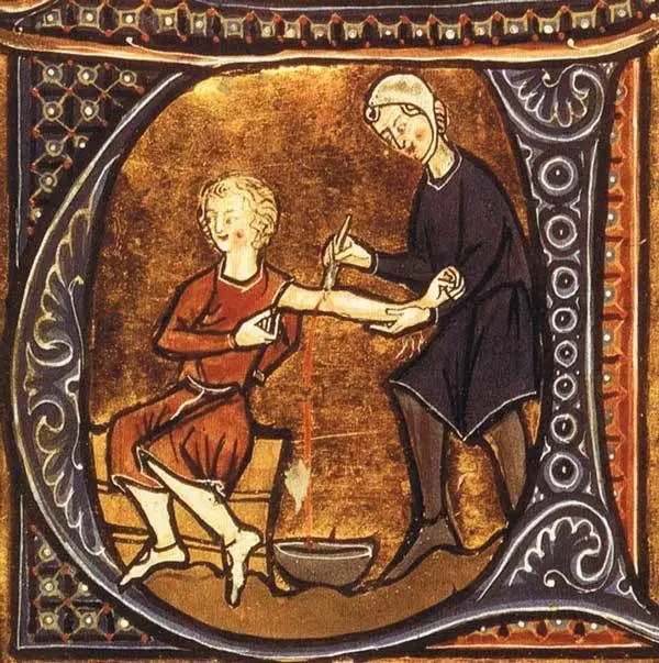 صورة من القرن الثالث عشر تظهر عملية الفصد (إراقة الدم)