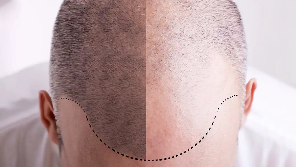 العلاقة بين فقدان الشعر والشيب