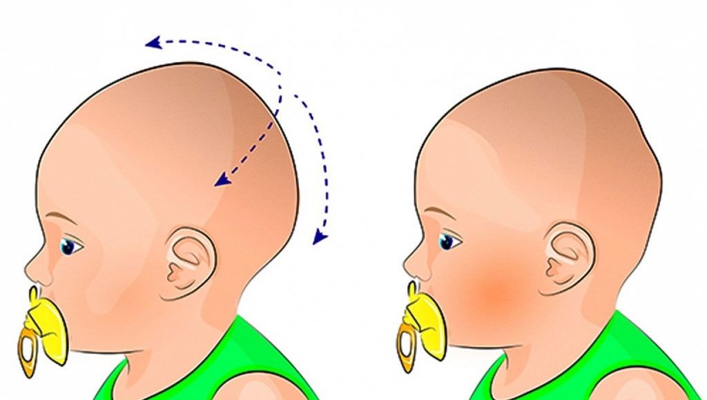 زيادة نمو حجم الرأس عند الطفل