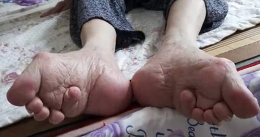 امرأة صينية مسنة مع أقدام مضمدة.