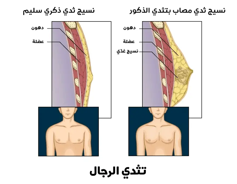 تثدي الذكور