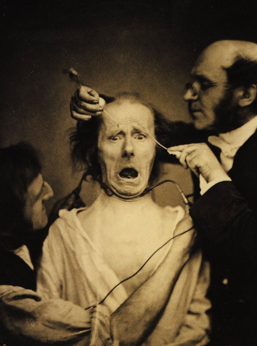 أحد مرضى (بولوني) في صورة التقطت خلال واحدة من تجاربه - صورة: Wikimedia Commons
