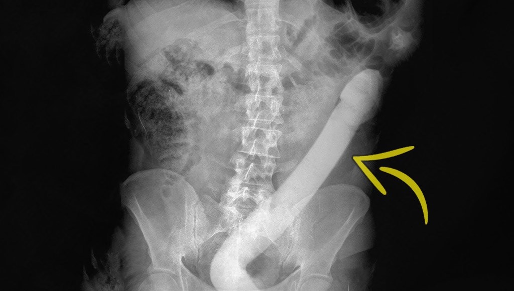 صورة بالأشعة السينية لأمعاء شخص تحتوي على قضيب اصطناعي