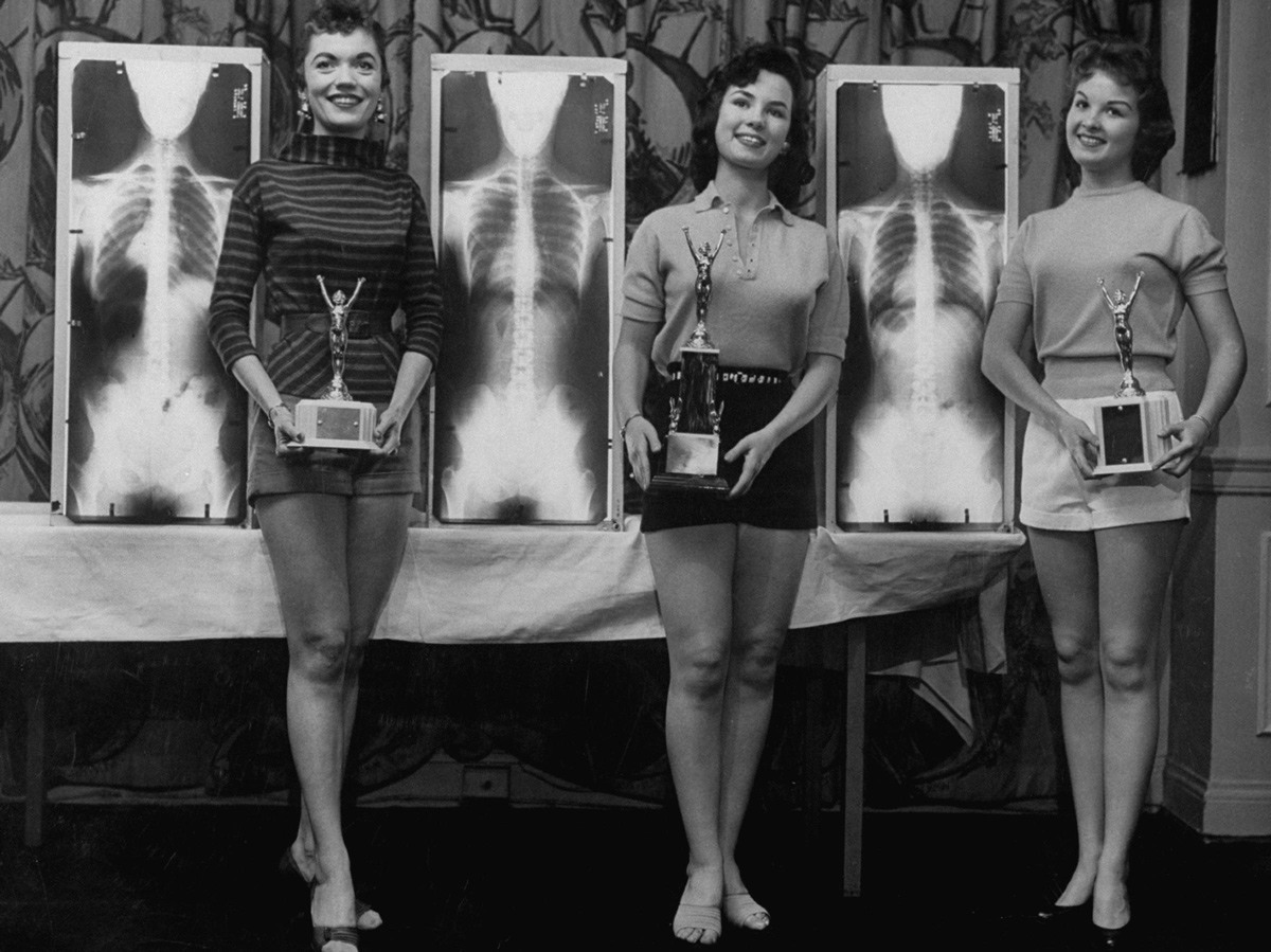 ترتيب المتسابقات (اليمين إلى اليسار)، (ماريان بابا) في المركز الثاني، و(لويس كونواي) ملكة جمال الوقفة المثالية، و(روث سوينسون) في المركز الثالث، وهن يحملن الجوائز التي حصلن عليها وبجانب كل واحدة منهن صورة الأشعة السينية الخاصة بها، وذلك في مؤتمر شيكاغو لعلاجات تقويم العمود الفقري اليدوية في مايو 1956 - صورة: Wallace Kirkland/LIFE