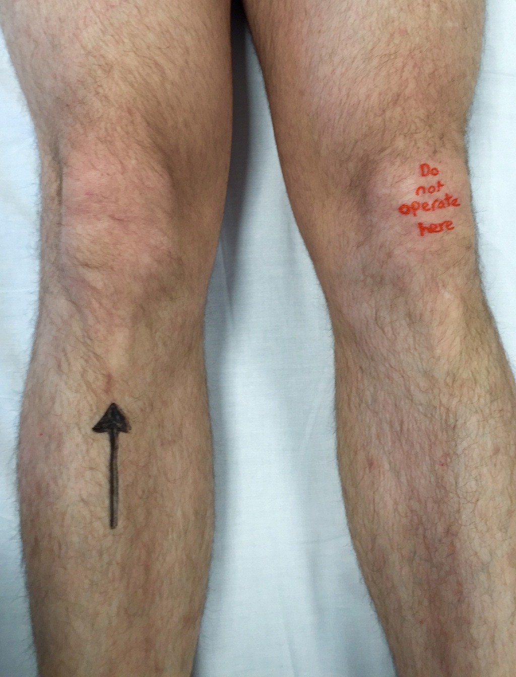 مكتوب على الركبة اليسرى: ”لا تجري العملية على هذه الركبة“. صورة: Gerry Gormley