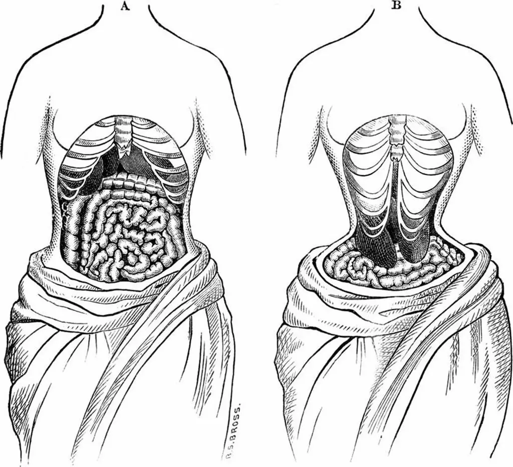 صورة من إحدى الكتب تظهر الشكل الطبيعي لتوضع أعضاء الجسم (على اليسار)، بينما تُظهر الصورة على اليمين التشوه الحاصل عند ارتداء الكورسيه. صورة wikimedia commons.