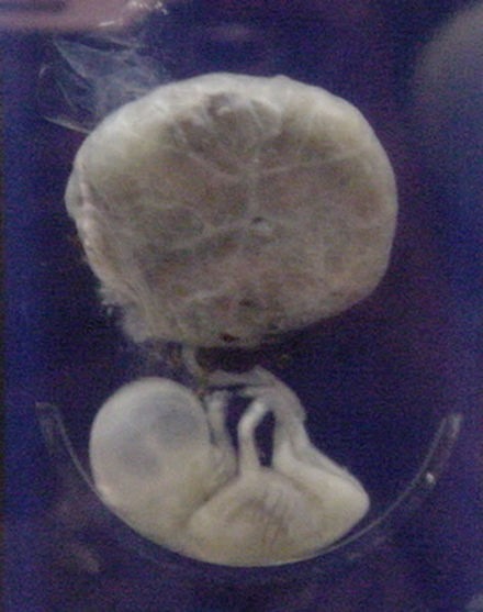 جنين بشري عمره ثلاثة أشهر متصل بالمشيمة، عام 2005.