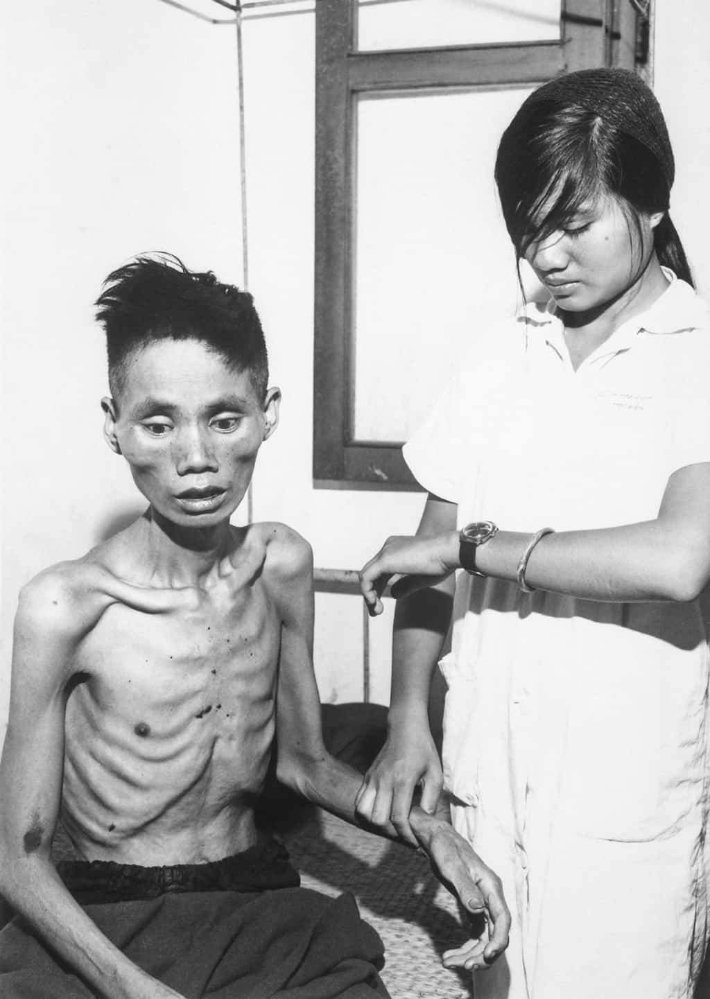 رجل فيتنامي يعاني من المجاعة